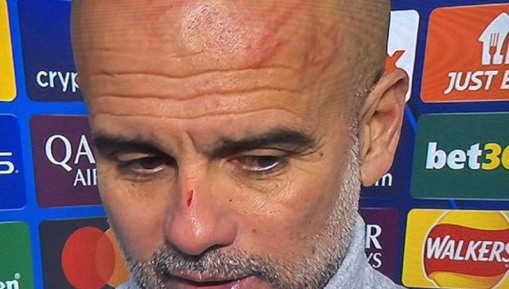 Seriously now: Guardiola addresses scratches on his face and issues warning